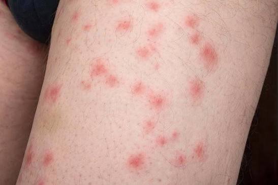 Red, Itchy Bite Marks